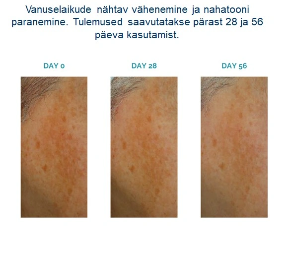 Pildil näha melasma etapiline vähenemine 56 päeva jookusu peale Profederm Exoretin serum kasutamist